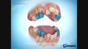 کشیدن سریال دندان