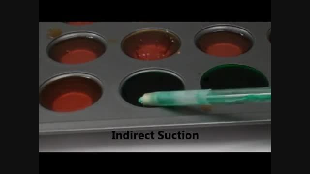 Direct and Indirect Suction