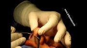 فیلم عمل جراحی بینی دکتر حسنانی