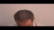 نمونه هائی از کاشت مو در کلینیک دکتر رضائی- قسمت اول