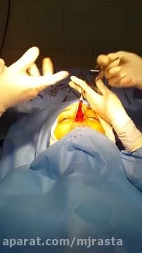 ( Nose surgery Dr.Rasta Videos (Documentary 5