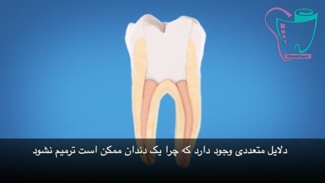 درمان مجدد ریشه دندان | سیمادنت
