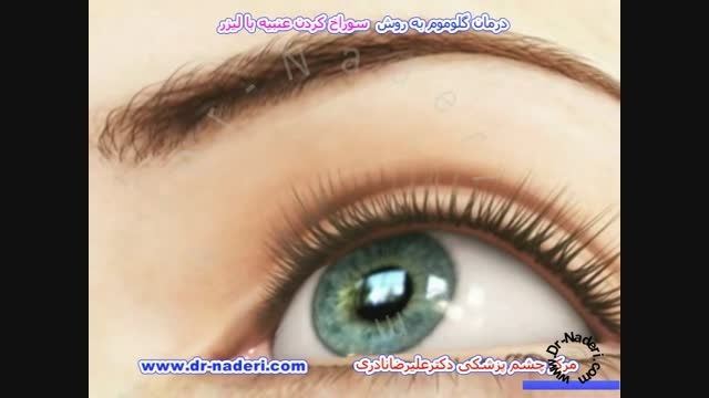 درمان گلوکوم بالیزرایریدوتومی -مرکز چشم پزشکی دکترنادری