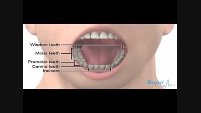 در اوردن دندان عقل
