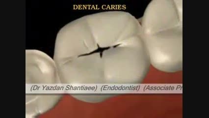 1) درمان ریشه دندان