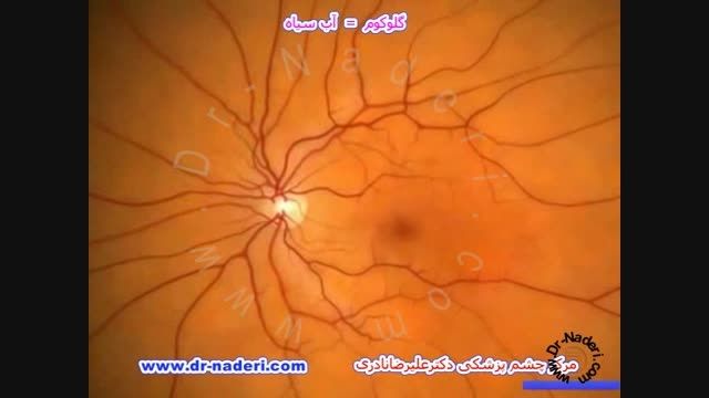 گلوکوم یاآب سیاه چیست؟ مرکز چشم پزشکی دکتر علیر ضانادری