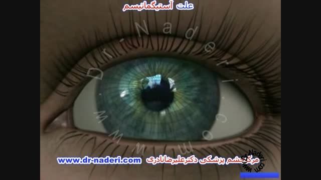 علت آستیگماتیسم -مرکز چشم پزشکی دکتر علیرضا نادری