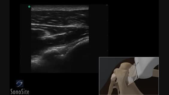 دکتر باقرزادی: 3d Ultrasound Guided Shoulder injection