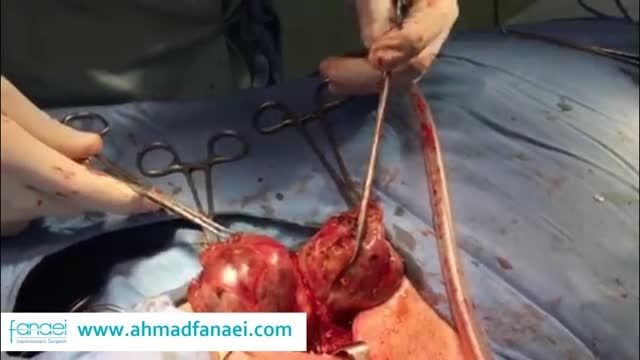 دکتر احمد فنایی: تیروئیدکتومی (جراحی تیروئید)