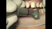 لمینیت Dental Laminate