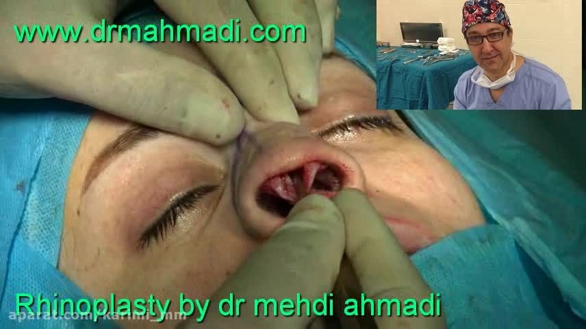 عمل زیبایی بینی(rhinoplasty)توسط متخصص گوش وحلق بینی25