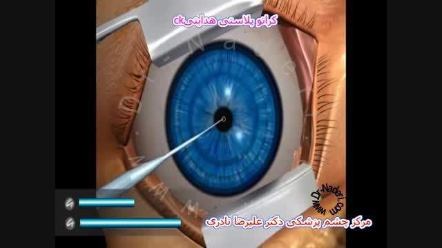 عمل کراتوپلاستی هدایتی-مرکز چشم پزشکی دکتر علیرضا نادری
