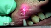 (laser diode)Terapia Wiser