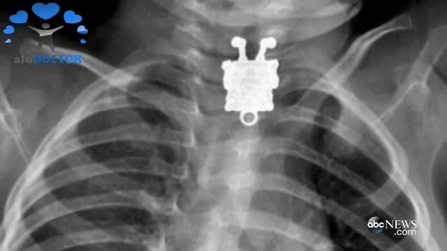عجیب اما واقعی: باب اسفنجی در عکس رادیولوژی یک کودک