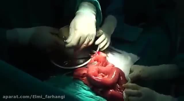 جراحی بیرون کشیدن آسکاریس از روده