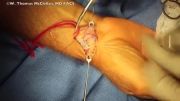 جراحی کیست دست