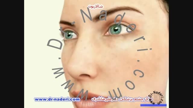 شالازیون - مرکز چشم پزشکی دکتر علیرضا نادری