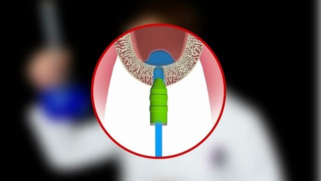 انیمیشن جراحی سینوس لیفت سیستم ایمپلنت LUNA