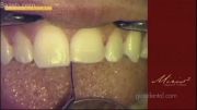 دندانپزشکی -  ترمیم با استفاده از روش لایه بندی طبیعی