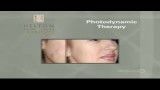 PWTV-Photodynamic-Therapy-for_Photo_Aging