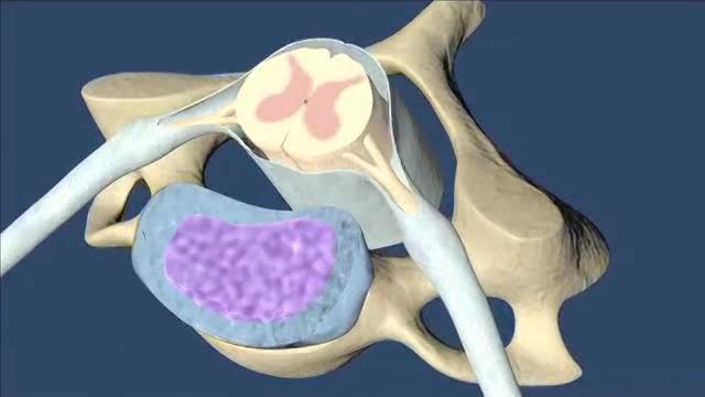 Herniated Disk Animation