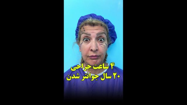 4 ساعت جراحی ، 20 سال جوانتر شدن | جراحی دیپ پلین لیفت صورت و گردن