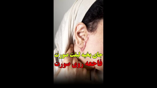 جای بخیه لیفت صورت (اسکار هایپرتروفیک) - درجراحی با کشیدن پوست