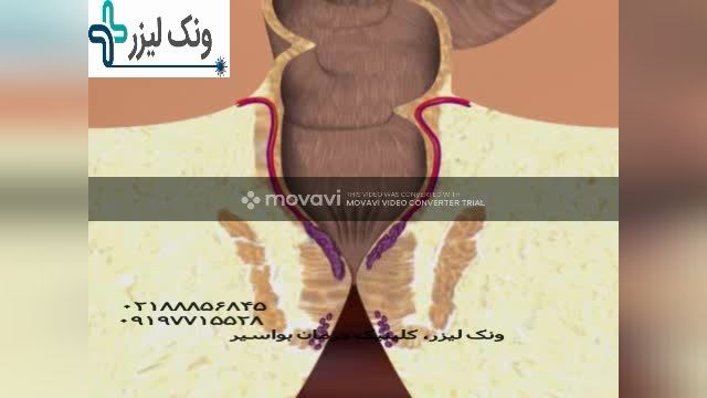 ونک لیزر کلینیک درمان بواسیر به بهترین روش