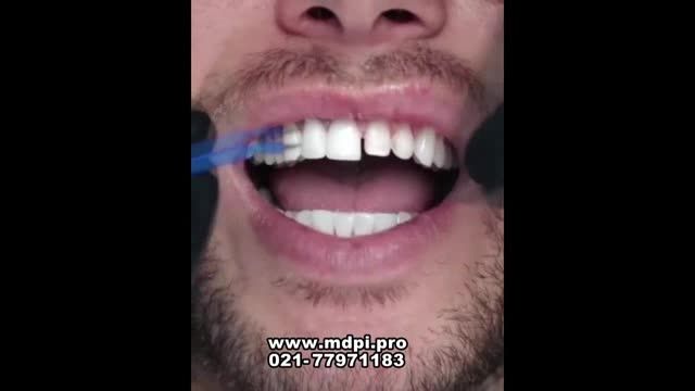 لمینت های دندان چگونه انجام میگیرند 