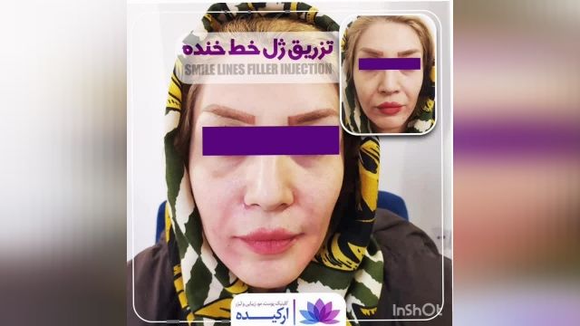 تزریق ژل خط خنده  در کلینیک تخصصی  ارکیده 