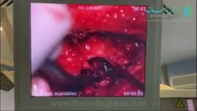 عمل جراحی دیسک far lateral
