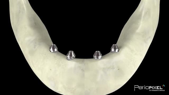 دندان مصنوعی ثابت به روش All on four