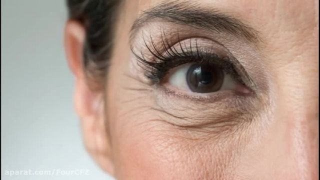 راه درمان - از بین بردن چروک دور چشم با روش طبیعی و بدون تزریق بوتاکس