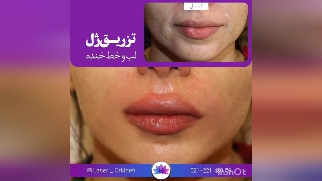 تزریق ژل خط خنده ولب  در کلینیک ارکیده 