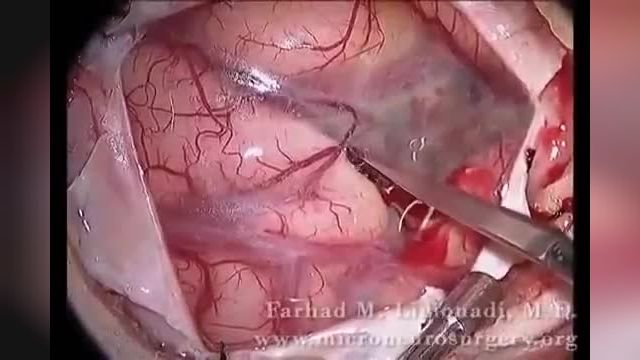 ویدیو کلیپ جراحی تومور مغزی