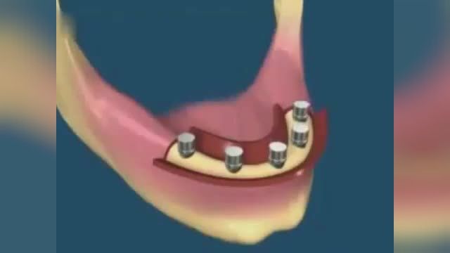 ثابت کردن دندان مصنوعی