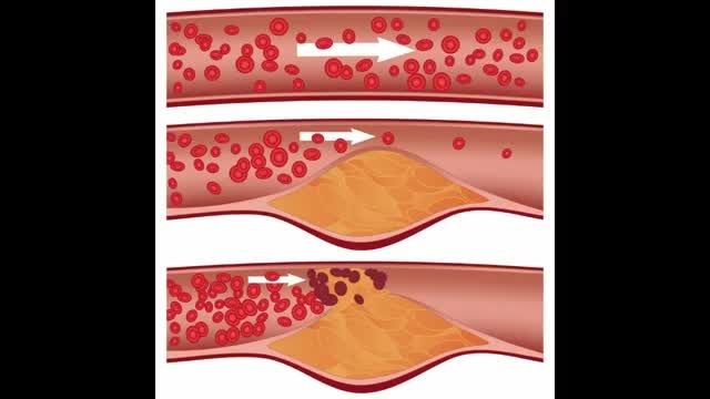 علائم و نشانه های چربی خون - روش خاص کاهش چربی خون سریع