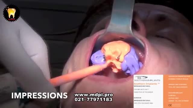 دانلود فیلم ایمپلنت دندان - کاشت ایمپلنت در یک روز