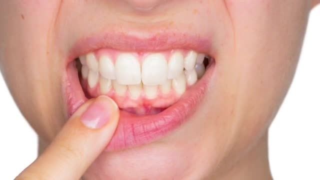 روش از بین بردن بوی بد دهان - آموزش از بین بردن عفونت دهان