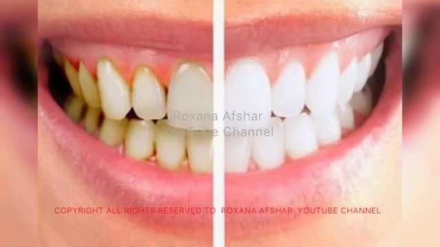 آموزش جرم گیری دندان در منزل - سریعترین روش سفید کردن دندان ها