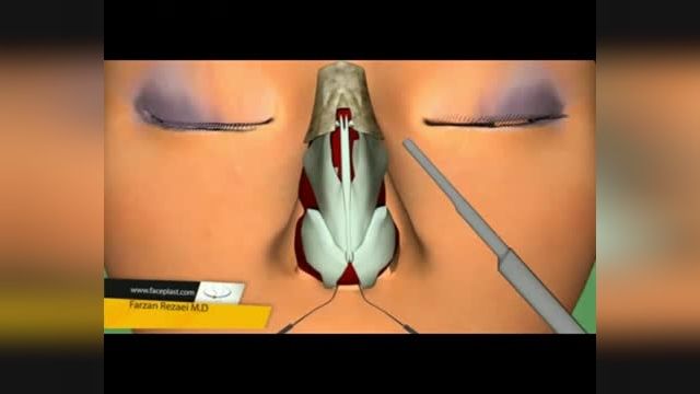 ویدیو آموزشی قبل جراحی بینی (رینوپلاستی) - فیلم عمل بینی استخوانی انیمیشن
