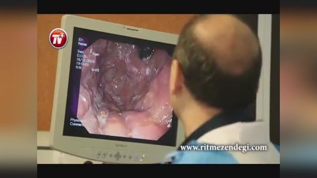 فیلم آندوسکوپی معده - آندوسکوپی روی یک بیمار مبتلا به زخم معده 