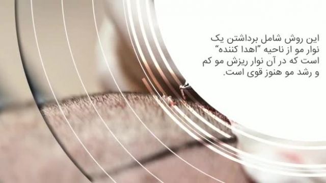 تولید محتوا | تبلیغ کاشت مو