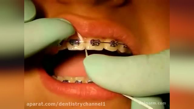 آموزش تصویری نخ دندان زدن مخصوص دندان های ارتودنسی شده !