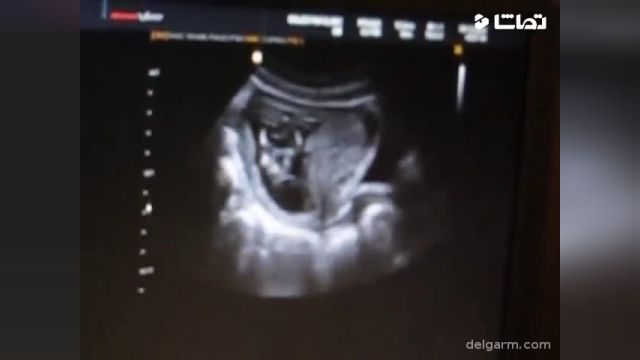 ویدیو تصویری از سونوگرافی هفته دوازدهم بارداری !