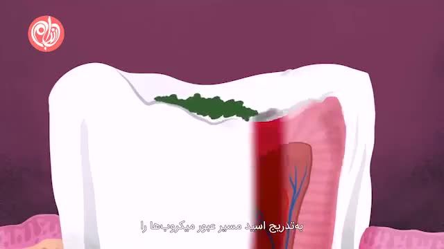 علت اصلی پوسیدگی دندان چیست؟ - چطور دچار پوسیدگی دندان می شویم؟