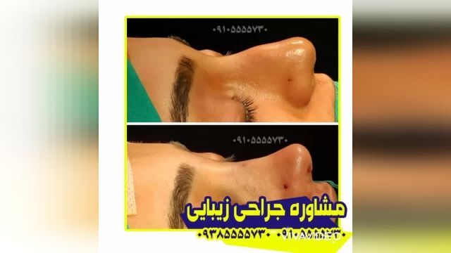 جراحی بینی گوشتی در کرمان