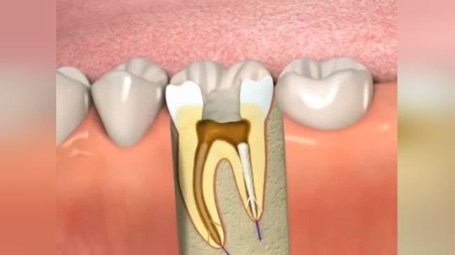 ببینید عصب کشی دندان چگونه انجام می شود؟