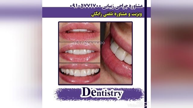 بلیچینگ دندان در مشهد