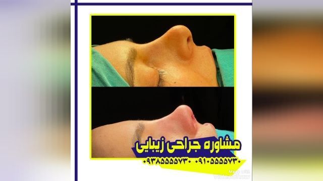 جراحی بینی طبیعی در کرمان